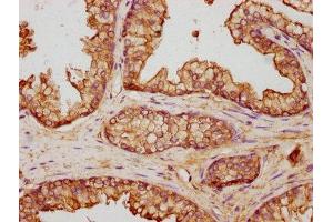 IHC image of ABIN7144281 diluted at 1:500 and staining in paraffin-embedded human prostate cancer performed on a Leica BondTM system. (Annexin V antibody  (AA 2-320))