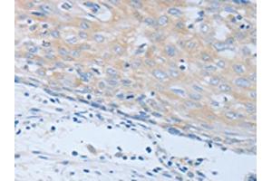 The image on the left is immunohistochemistry of paraffin-embedded Human cervical cancer tissue using ABIN7190248(CHRFAM7A Antibody) at dilution 1/40, on the right is treated with synthetic peptide. (CHRNA7 antibody)