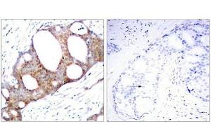 Immunohistochemical analysis of paraffin-embedded human breast carcinoma tissue using GSK3a(Phospho-Ser21) Antibody(left) or the same antibody preincubated with blocking peptide(right). (GSK3 alpha antibody  (pSer21))