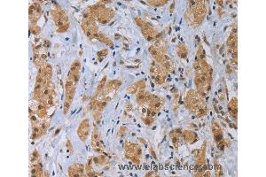 Immunohistochemistry of Human thyroid cancer using CLEC1A Polyclonal Antibody at dilution of 1:40 (CLEC1A antibody)