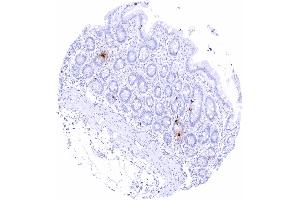 Duodenum mucosa Intense somatostatin staining of scattered neuroendocrine delta cells (Recombinant Somatostatin antibody)