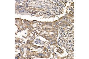 Immunohistochemistry of paraffin-embedded human lung cancer using IL11RA Rabbit mAb (ABIN7267984) at dilution of 1:150 (40x lens). (IL11RA antibody)