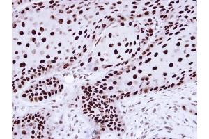 Immunohistochemical staining of paraffin-embedded Cal27 Xenograft using hnRNP C1/C2 antibody at a dilution of 1:100 (HNRNPC antibody)