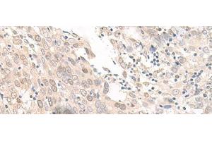 Immunohistochemistry of paraffin-embedded Human prost at e cancer tissue using OLA1 Polyclonal Antibody at dilution of 1:45(x200)