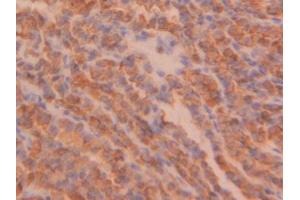 DAB staining on IHC-P; Samples: Human Thyroid cancer Tissue (PPIB antibody  (AA 47-216))