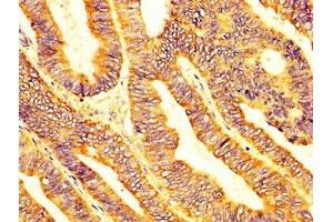 IHC image of ABIN7158752 diluted at 1:200 and staining in paraffin-embedded human colon cancer performed on a Leica BondTM system. (LPCAT2 antibody  (AA 442-544))