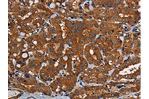 The image on the left is immunohistochemistry of paraffin-embedded Human thyroid cancer tissue using ABIN7191822(PDE5A Antibody) at dilution 1/50, on the right is treated with synthetic peptide. (PDE5A antibody)