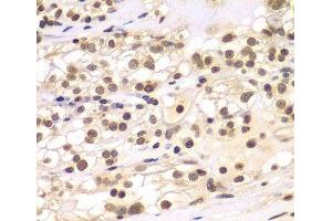 Immunohistochemistry of paraffin-embedded Human kidney cancer using ULK4 Polyclonal Antibody at dilution of 1:100 (40x lens). (ULK4 antibody)