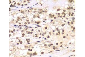Immunohistochemistry of paraffin-embedded Human kidney cancer using ULK4 Polyclonal Antibody at dilution of 1:100 (40x lens).