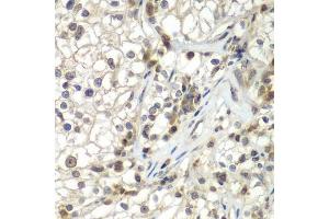 Immunohistochemistry of paraffin-embedded human kidney cancer using ASPSCR1 antibody. (ASPSCR1 antibody  (AA 284-553))