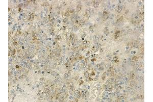 ABIN6259068 and ABIN6273452 at 1/100 staining human melanoma by IHC-P.