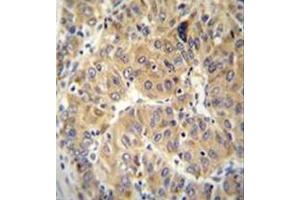 Immunohistochemistry analysis in formalin fixed and paraffin embedded human hepatocarcinoma reacted with NARS Antibody (N-term) followed which was  peroxidase conjugated to the secondary antibody and followed by DAB staining. (NARS antibody  (N-Term))