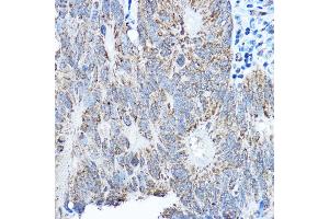 Immunohistochemistry of paraffin-embedded human colon carcinoma using SMOC1 antibody (ABIN7270511) at dilution of 1:250 (40x lens). (SMOC1 antibody  (AA 27-250))