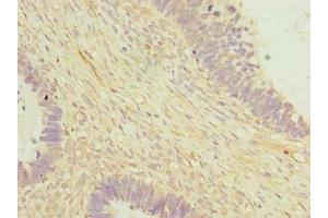 Immunohistochemistry of paraffin-embedded human ovarian cancer using ABIN7149808 at dilution of 1:100 (OTUD6B antibody  (AA 1-293))