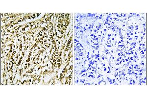 Immunohistochemistry analysis of paraffin-embedded human breast carcinoma tissue using FEN1 antibody. (FEN1 antibody)