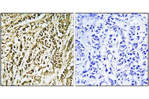 Immunohistochemistry analysis of paraffin-embedded human breast carcinoma tissue using FEN1 antibody.