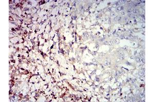 Immunohistochemical analysis of paraffin-embedded stomach cancer tissues using CD39 mouse mAb with DAB staining. (CD39 antibody  (AA 38-179))