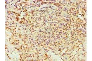 Immunohistochemistry of paraffin-embedded human breast cancer using ABIN7170761 at dilution of 1:100 (ESRRA antibody  (AA 1-423))