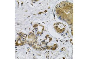 Immunohistochemistry of paraffin-embedded human breast cancer using NCF4 Antibody (ABIN5971122) at dilution of 1/100 (40x lens). (NCF4 antibody)