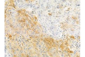 ABIN6256940 and ABIN6274855 at 1/100 staining human tongue carcinoma by IHC-P. (Apolipoprotein F antibody  (C-Term))