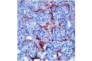 MMP9 in humanprostate cancer was detected using HRP/AEC red color stain. (MMP 9 antibody  (N-Term))