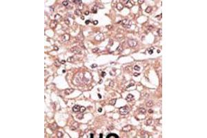 Formalin-fixed and paraffin-embedded human cancer tissue reacted with the primary antibody, which was peroxidase-conjugated to the secondary antibody, followed by AEC staining. (TLR7 antibody  (N-Term))