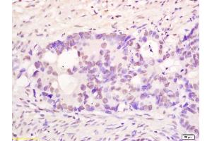 Formalin-fixed and paraffin embedded human colon carcinoma labeled with Anti PMS1 Polyclonal Antibody, Unconjugated (ABIN1387537) at 1:200 followed by conjugation to the secondary antibody and DAB staining (PMS1 antibody  (AA 21-120))