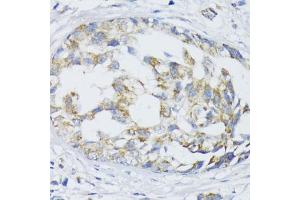 Immunohistochemistry of paraffin-embedded human mammary cancer using SLC30 antibody (2532) at dilution of 1:100 (40x lens). (SLC30A1 antibody  (AA 250-350))