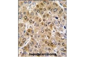 Formalin-fixed and paraffin-embedded human hepatocarcinoma tissue reacted with DDX5 antibody (C-term) (ABIN391668 and ABIN2841579) , which was peroxidase-conjugated to the secondary antibody, followed by DAB staining. (DDX5 antibody  (C-Term))