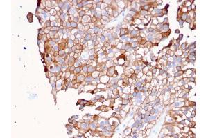 Formalin-fixed, paraffin-embedded human Urothelial Carcinoma stained with Uroplakin 1B Mouse Monoclonal Antibody (UPK1B/3081). (Uroplakin 1B antibody  (AA 109-229))