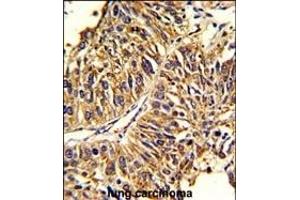 Formalin-fixed and paraffin-embedded human lung carcinoma reacted with HMGCS1 Antibody (Center), which was peroxidase-conjugated to the secondary antibody, followed by DAB staining. (HMGCS1 antibody  (AA 290-317))