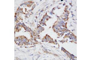 Anti-Osteopontin antibody, IHC(P) IHC(P): Human Mammary Cancer Tissue