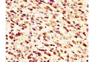 IHC image of ABIN7159800 diluted at 1:300 and staining in paraffin-embedded human glioma performed on a Leica BondTM system.