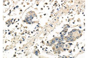 ABIN6261815 and ABIN6278146 at 1/100 staining Human gastric cancer by IHC-P. (FRAT1 antibody  (C-Term))