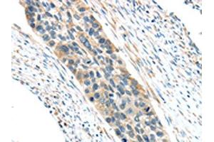 The image on the left is immunohistochemistry of paraffin-embedded Human esophagus cancer tissue using ABIN7193036(VWCE Antibody) at dilution 1/30, on the right is treated with synthetic peptide. (VWCE antibody)