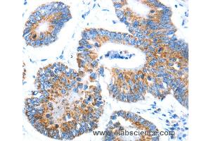 Immunohistochemistry of Human colon cancer using AIFM1 Polyclonal Antibody at dilution of 1:30 (AIF antibody)