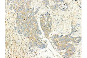 ABIN6266056 and ABIN6268656 at 1/100 staining Human breast cancer by IHC-P.