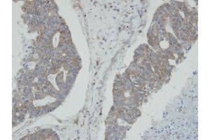 IHC-P Image Immunohistochemical analysis of paraffin-embedded human endo mitral ovarian cancer, using NMI, antibody at 1:100 dilution. (NMI antibody)