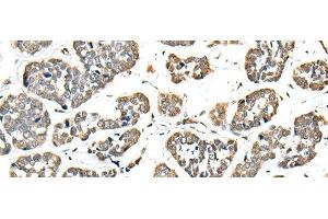 Immunohistochemistry of paraffin-embedded Human esophagus cancer tissue using EEF1E1 Polyclonal Antibody at dilution of 1:35(x200) (EEF1E1 antibody)