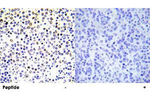 Immunohistochemical analysis of paraffin-embedded human malignant lymphoma tissue using HIST1H3E polyclonal antibody . (HIST1H3E antibody)