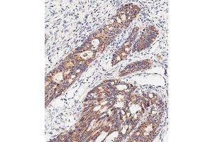 Immunohistochemical analysis of paraffin-embedded human colon carcinoma tissue using (ABIN651547 and ABIN2840295) performed on the Leica® BOND RXm. (SLC47A1 antibody  (C-Term))