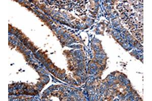 The image on the left is immunohistochemistry of paraffin-embedded Human cervical cancer tissue using ABIN7190708(FPR2 Antibody) at dilution 1/17, on the right is treated with synthetic peptide. (FPR2 antibody)