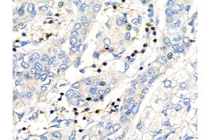 ABIN6260619 and ABIN6276857 at 1/100 staining Human liver cancer by IHC-P.