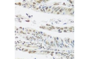 Immunohistochemistry of paraffin-embedded human colon carcinoma using SNAI1 antibody. (SNAIL antibody)
