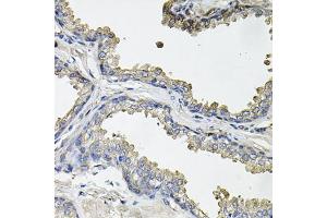 Immunohistochemistry of paraffin-embedded human prostate using ACO1 antibody (ABIN5995389) at dilution of 1/100 (40x lens). (Aconitase 1 antibody)
