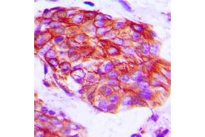 Immunohistochemical analysis of Claudin 6 staining in human prostate cancer formalin fixed paraffin embedded tissue section. (Claudin 6 antibody  (Center))