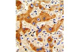 Formalin-fixed and paraffin-embedded human hepatocarcinoma reacted with Glucagon Antibody (N-term), Cat.