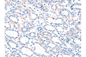 The image on the left is immunohistochemistry of paraffin-embedded Human thyroid cancer tissue using ABIN7128186(ACSM5 Antibody) at dilution 1/35, on the right is treated with fusion protein. (ACSM5 antibody)