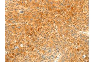 The image on the left is immunohistochemistry of paraffin-embedded Human liver cancer tissue using ABIN7131139(SOCS6 Antibody) at dilution 1/35, on the right is treated with fusion protein. (SOCS6 antibody)