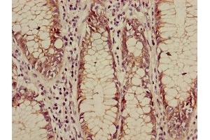 Immunohistochemistry of paraffin-embedded human colon cancer using ABIN7146984 at dilution of 1:100 (CTNNB1 antibody  (AA 2-781))